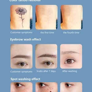 Láser Neodimio Yag para eliminar tatuaje,acné.